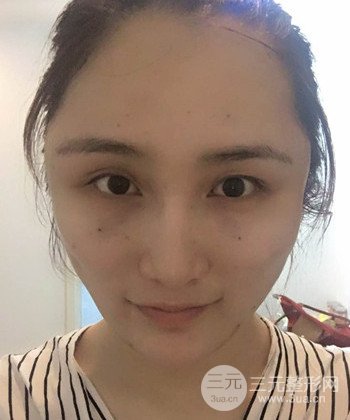 面部埋埋蛋白線.提升前后對(duì)比照片，皮膚緊致了不少