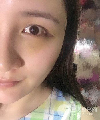 面部埋埋蛋白線.提升前后對(duì)比照片，皮膚緊致了不少