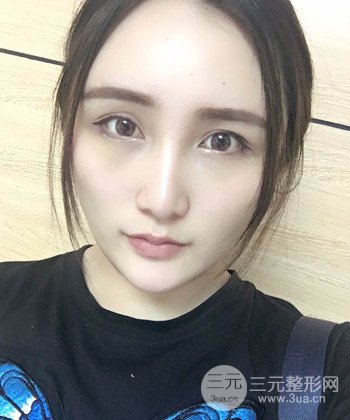 面部埋埋蛋白線.提升前后對(duì)比照片，皮膚緊致了不少