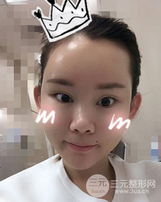 南昌永康自體脂肪面部填充兩個半月果圖