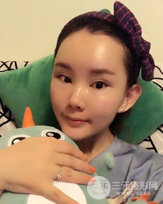 南昌永康自體脂肪面部填充兩個半月果圖