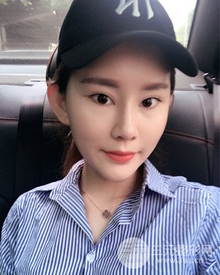 南昌永康自體脂肪面部填充兩個半月果圖