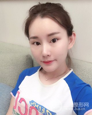 南昌永康自體脂肪面部填充兩個半月果圖