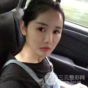 南京米尚恩陳天杰自體脂肪填充全臉 女神的養(yǎng)成記！
