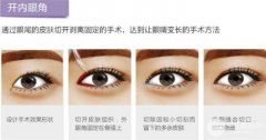 開內(nèi)眼角會回縮嗎|開內(nèi)眼角前后對比圖分享