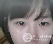 開外眼角前后對比圖分享：性感從眼睛開始