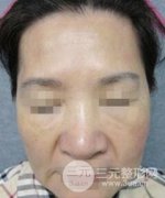 瑞藍(lán)2號(hào)除皺果前后對(duì)比圖：60歲的我還能返老還童！