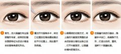 開內(nèi)眼角后遺癥|開內(nèi)眼角前后對比照片