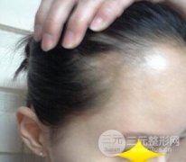 植鬢角需要多少錢？兩位妹紙的真實案例來為您解答！