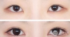 開內(nèi)眼角有風(fēng)險嗎，開內(nèi)眼角多久恢復(fù)自然