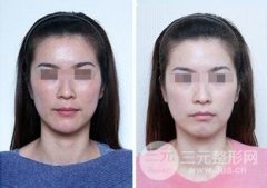 全身光子嫩膚多少錢(qián)  百里守約告訴你