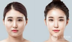 假體隆下巴價(jià)格是多少？與哪些因素有關(guān)？