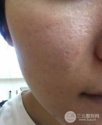 果酸換膚的果怎么樣？果酸換膚真實經驗來分享~