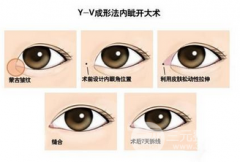 自貢西嬋整形醫(yī)院開眼角手術(shù)多少錢