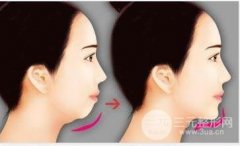 北京做假體墊下巴手術(shù)要多少錢(qián)？附上恢復(fù)期注意事項(xiàng)