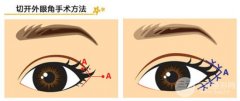 開內(nèi)眼角會回縮嗎 果好不好