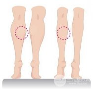 打注射瘦腿要多少錢(qián) 瘦腿果好不好