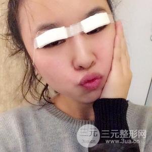 割雙眼皮案例和恢復(fù)過(guò)程真人分享