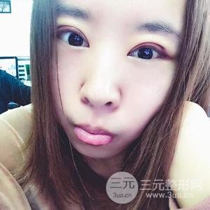 割雙眼皮案例和恢復(fù)過(guò)程真人分享