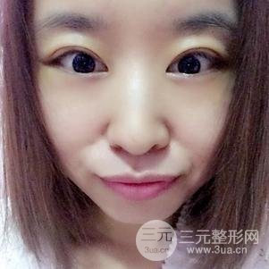 割雙眼皮案例和恢復(fù)過(guò)程真人分享