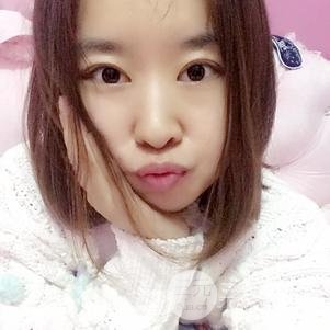 割雙眼皮案例和恢復(fù)過(guò)程真人分享