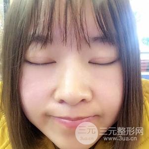 割雙眼皮案例和恢復(fù)過(guò)程真人分享