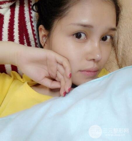 鼻頭縮小術(shù)過(guò)程圖,鼻頭縮小恢復(fù)日記