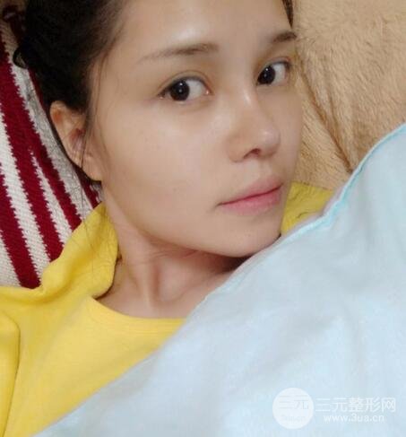 鼻頭縮小術(shù)過(guò)程圖,鼻頭縮小恢復(fù)日記