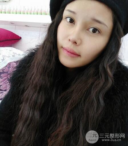 鼻頭縮小術(shù)過(guò)程圖,鼻頭縮小恢復(fù)日記