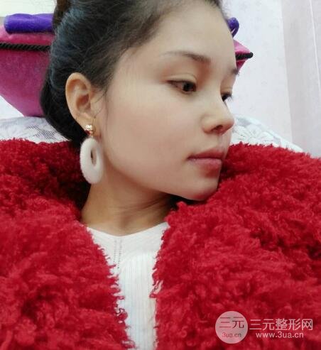 鼻頭縮小術(shù)過(guò)程圖,鼻頭縮小恢復(fù)日記