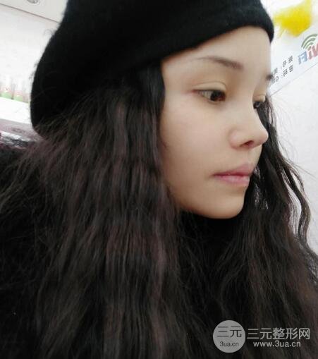 鼻頭縮小術(shù)過(guò)程圖,鼻頭縮小恢復(fù)日記