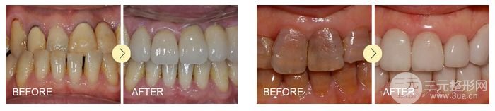 四環(huán)素牙如何變白、牙齒變白具體方法有哪些