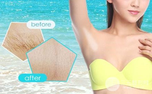 激光脫毛還會再長嗎、腋窩激光脫毛多少錢