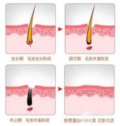 激光脫毛多長(zhǎng)時(shí)間一次