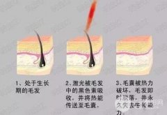 藝星整形：激光脫毛多久做一次?