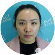 光子嫩膚的費用是多少錢？真實緩解過程果圖片對比分享~