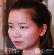 墊下巴什么材料好？杭州時(shí)光玻尿酸注射圖片案例分享~