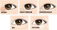 北京雙眼皮開眼角需要多少錢？