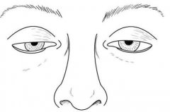 做上瞼下垂一般多少錢？果怎么樣？