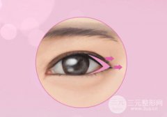 開內(nèi)外眼角有什么危害？前后對比圖一覽