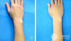 鄭州手臂激光脫毛多少錢