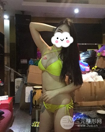 襄陽(yáng)自體脂肪隆胸真人案例,恢復(fù)過(guò)程及果分享