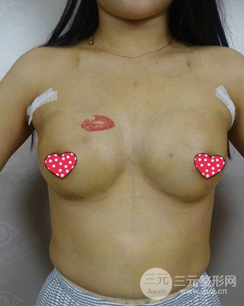 襄陽(yáng)自體脂肪隆胸真人案例,恢復(fù)過(guò)程及果分享