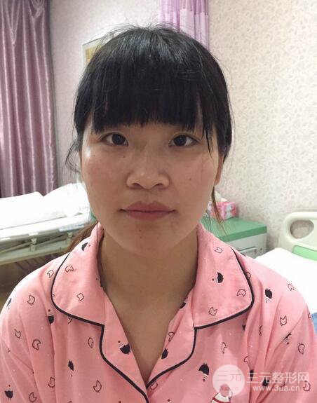 隆鼻鼻翼縮小全過程和術(shù)后照片分享，隨意揉捏很OK