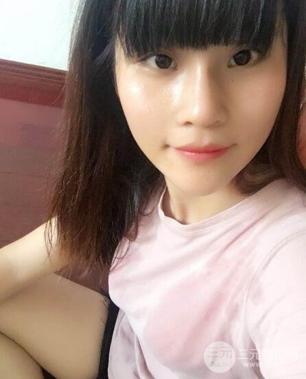 隆鼻鼻翼縮小全過程和術(shù)后照片分享，隨意揉捏很OK