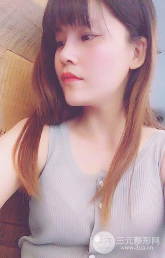 隆鼻鼻翼縮小全過程和術(shù)后照片分享，隨意揉捏很OK