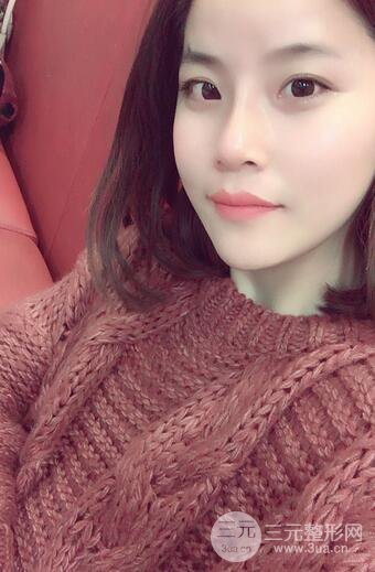 隆鼻鼻翼縮小全過程和術(shù)后照片分享，隨意揉捏很OK