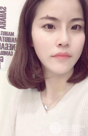 隆鼻鼻翼縮小全過程和術(shù)后照片分享，隨意揉捏很OK