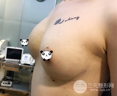 自體脂肪隆胸術(shù)后恢復(fù)過程分享|成功落實(shí)變大胸的愿望