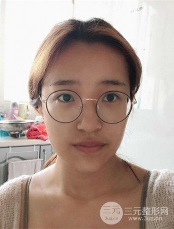 上海面部脂肪填充一個月果超明X、妥妥減齡十歲！